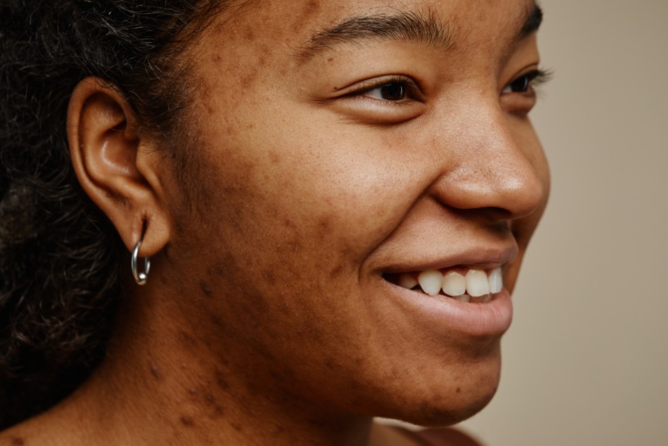A Complete Guide to Portrait Retouching Workflow Blemish removal before picture
on Aftershoot
